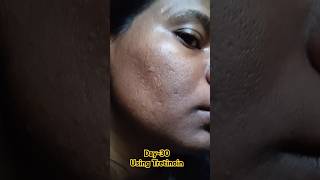 Day30 Using Tretinoin 0025 Cream viralvideo tretinoin skincare shorts youtubeshorts [upl. by Enelyad851]