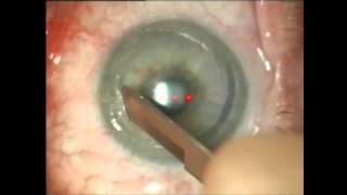 Phototherapeutic Keratectomy  Superficial Keratectomy for Irregular Astigmatism West Des Moines Iow [upl. by Concoff]