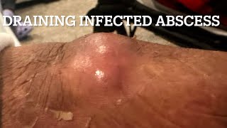 Draining my dad’s infected abscess [upl. by Ereveneug]