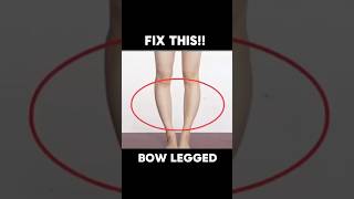 Exercise for BOW LEGGED ✅👍 bowlegs shortsfeed shortsvideo [upl. by Nahtannhoj]