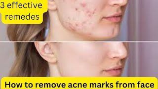 HOW TO REMOVE ACNE MARKS FROM FACE  3 EASY AND EFFECTIVE REMEDIES [upl. by Anrehs]