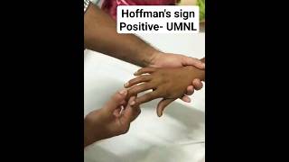 Hoffmans Sign Babinski of Upper Limb mbbs [upl. by Anatlus399]