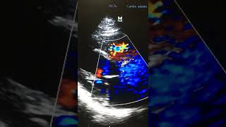 Estenosis Valvular Aòrtica po Ecocardiografia Doppler color Plano Para sete al [upl. by Annawyt]