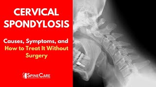 CERVICAL SPONDYLOSIS Causes Symptoms and Treatment NO SURGERY [upl. by Aynekat]