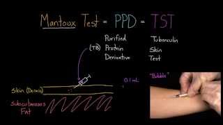 Mantoux Test aka PPD or TST [upl. by Ahter]