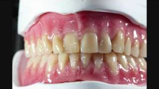 Elite Dental Studios Gerber denture setup for Candulor competition [upl. by Buatti]