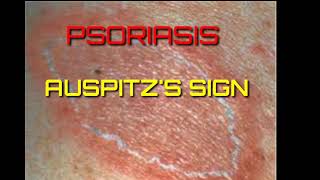 Auspitzs sign demonstrationGrattage testpsoriasis [upl. by Bruns136]