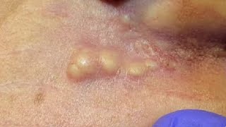 Whiteheads Blackheads Extractions on the Ear [upl. by Sinnard783]