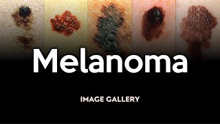 Melanoma Image Gallery [upl. by Ibbor]