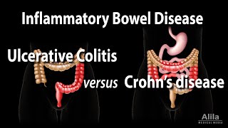 Ulcerative Colitis versus Crohns Disease Animation [upl. by Arymas822]