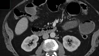 Gallstone ileus [upl. by Angi]