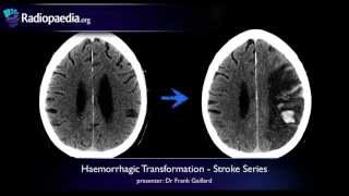 Stroke Haemorrhagic transformation  radiology video tutorial CT MRI [upl. by Enahsed]