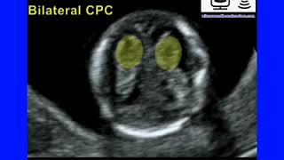 Choroid Plexus Bilateral Cysts [upl. by Thea]