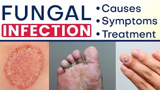 ✅ Fungal Infection क्या और कैसे होता है ✅ Fungal Infection Symptoms Causes and Treatment in Hindi [upl. by Anum774]