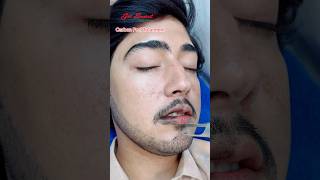 Carbon Peel Laser Treatment getsmarthairclub viralvideo beauty laserhairtreatment laser [upl. by Nadeau127]