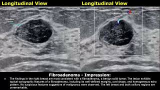 Fibroadenoma Breast Ultrasound Report Example  Benign Tumors USG Scan Report Findings amp Impression [upl. by Stroup]