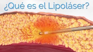 Liposucción Láser ¿Qué es el Lipoláser y Para Qué Sirve [upl. by Claiborne]