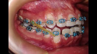 Elásticos Intermaxilares  Mira como ayudan en tu tratamiento con brackets☝ [upl. by Littlejohn]