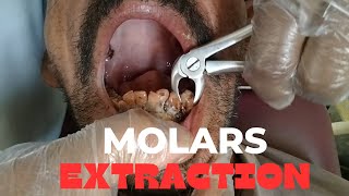 Lower Molars Extraction  molar extraction  molars teeth removal [upl. by Deina]