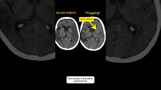 Ischemic Stroke  Fogging Phenomenon radiology radiologystudent medicalstudent [upl. by Lebezej843]