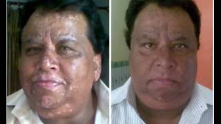 FREE MEDICINE OF WHITE PATCHES LEUCODERMA [upl. by Argyle]