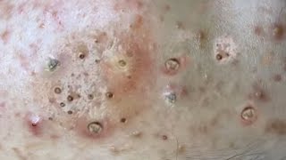 Satisfying big blackhead removal Pimple popping [upl. by Nylicaj]