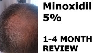 Minoxidil Hair Regrowth  Before amp After 14 Months [upl. by Shamus26]