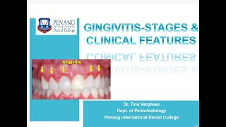 GINGIVITIS STAGES amp CLINICAL FEATURES [upl. by Stephine]