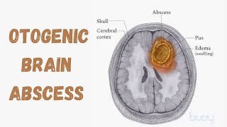 Otogenic Brain Abscess  Intracranial Complication Of Suppurative Otitis Media [upl. by Lavinie]