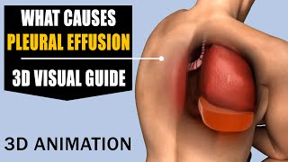 Pleural Effusion Explained Causes Symptoms Diagnosis and Treatment pleuraleffusion [upl. by Claudelle]