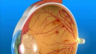 Understanding Proliferative Diabetic Retinopathy [upl. by Ethelin325]