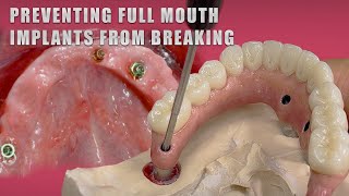 Preventing Full Mouth Implants from Breaking [upl. by Dickson]