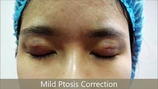 Ptosis Correction by Short incision 23 mm [upl. by Nakre188]