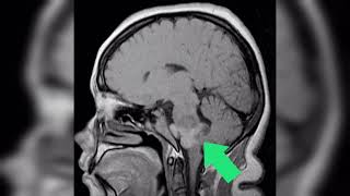 GLIOMA TUMOR DEL TALLO CEREBRAL CAUSAS SÍNTOMAS Y TRATAMIENTO [upl. by Whiffen]