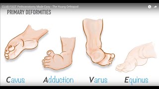 Types of Congenital talipes Talipes equinovarus  Cavus  Equinus [upl. by Yajet]