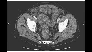 Thrumbprints bei ischämischer Colitis [upl. by Ahsita]