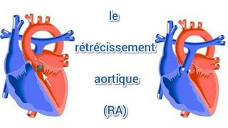 تضيق الأبهر Le rétrécissement aortique [upl. by Sallee]