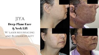 JIYA  DeepPlane Face amp Neck Lift  Upper amp Lower Blepharoplasty w Ultraclear Resurfacing [upl. by Eixor]