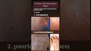 Dermatological signs papules acne acnetreatment psoriasis plaques [upl. by Uokes89]