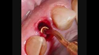 piezosurgery mis c1 implant immediate loading in fresh socket dr sepe [upl. by Nylkaj617]