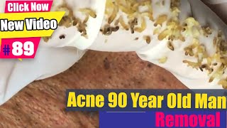 Acne 90 Year old man many blackheads  Acne Treatment 89 [upl. by Danya66]