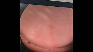 cystoscopy of common cloaca of 7 years female child with covering colostomy [upl. by Obe18]