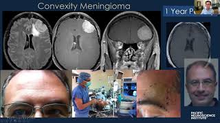 Keyhole Meningioma Removal with Dr Daniel Kelly [upl. by Kihtrak]