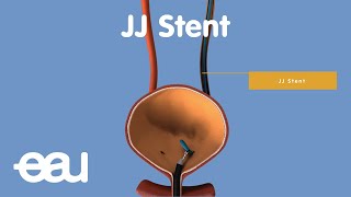 Behandlung von Nieren und Harnleitersteinen JJstent [upl. by Eitnom]