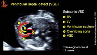 Fetal echocardiography at 1113 weeks Ventricular Septal Defect VSD [upl. by Leslee]