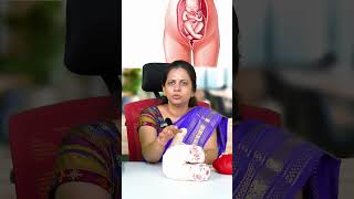 What is Breech Delivery  Dr Shilpa G B Gynecologist [upl. by Yruy19]