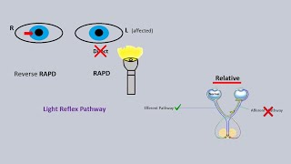 RAPD eye test  relative afferent pupillary defect  Marcus gunn pupil [upl. by Urquhart]