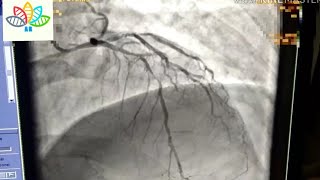 Coronary angiogram in cardiac catheterization procedures [upl. by Kcirrez791]