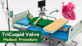 Tricuspid valve  Medical Procedure Animation [upl. by Naahs]