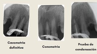 Endodoncia 22 [upl. by Zaneta630]